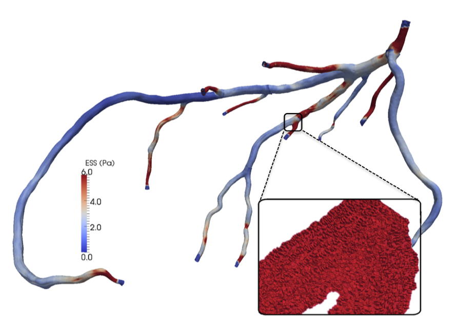 The geometry of human coronary arteries from a CTA scan, shown at 12.5 micron resolution. The inset shows blood-flow geometry detail. The red in the detail highlights red blood cells, not endothelial shear stress (ESS), which is represented as a color map on the arterial walls. (Image courtesy of the author.)